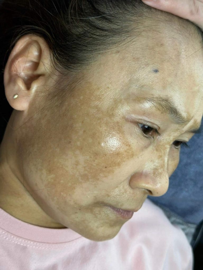 Nám da là một trong những vấn đề phổ biến mà hầu hết phụ nữ đều gặp phải