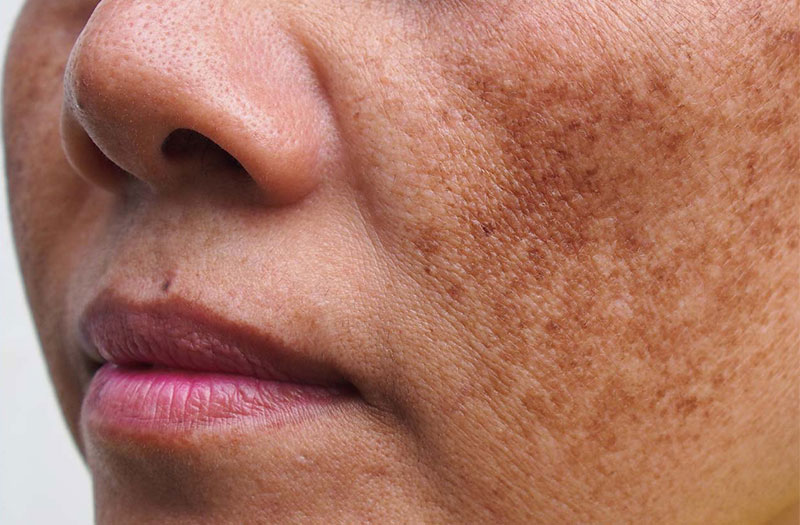 Nám chân đinh là một dạng rối loạn sắc tố da do sự lắng đọng quá mức của sắc tố melanin ở lớp hạ bì