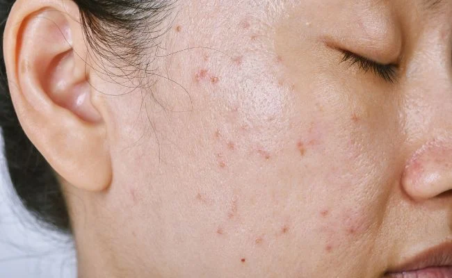 Da bị mụn thiếu những chất gì ?