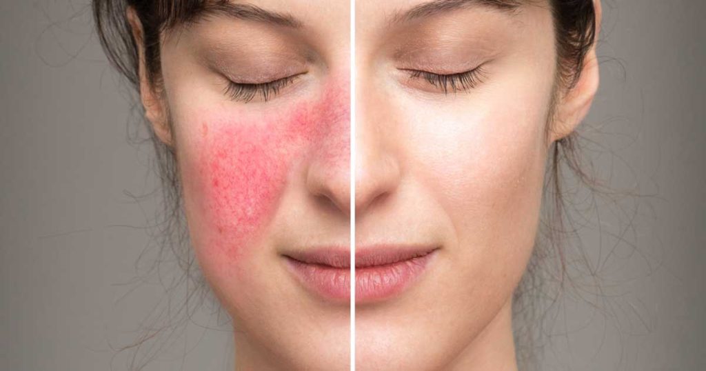 Tăng sắc tố sau laser là tình trạng vùng da điều trị trở nên sậm màu hơn do sự gia tăng của sắc tố melanin