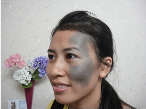 Bớt xanh là tình trạng tăng sắc tố da có màu xanh đen, không nổi lên bề mặt da.